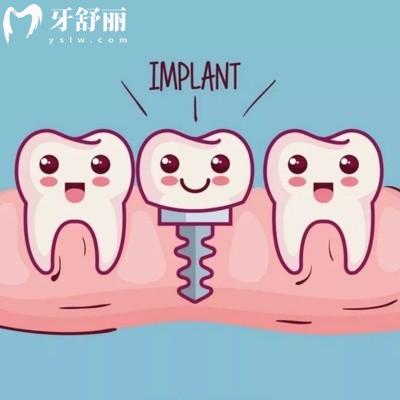 揭秘諾貝爾種植牙是瑞典的品牌質量好,get諾貝爾種植體三種檔次價格及區別